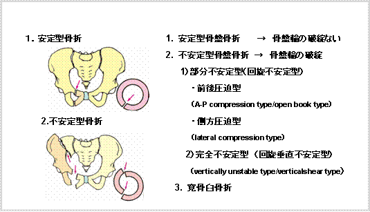骨盤骨折 寛骨臼骨折・骨盤輪骨折の手術手技【裁断済み】 - 生活/健康